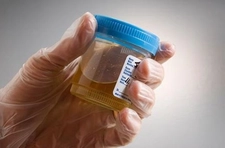 İdrar Tahlili Lökosit Tedavisi