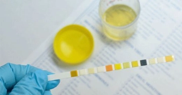 Gebelikte İdrarda Lökosit Değeri Kaç Olmalı?