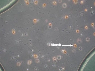 İdrarda Lökosit Olmasının Nedenleri?